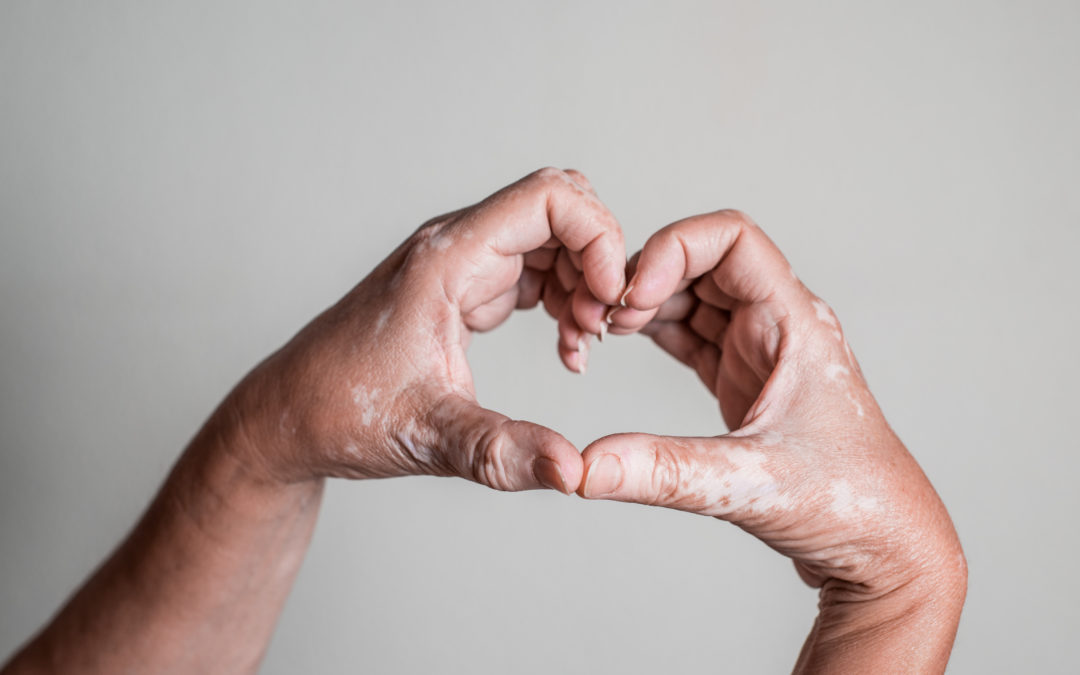 Θεραπεία λεύκης (Vitiligo)